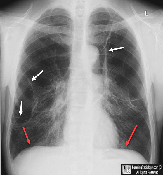 Bullous disease of the lungs-